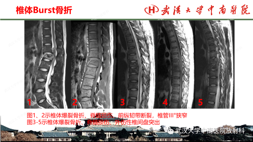 影像PPT - 【PPT】脊柱外伤的影像分析-16