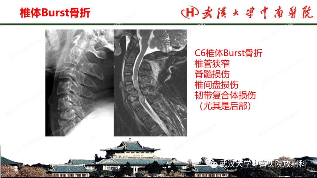 影像PPT - 【PPT】脊柱外伤的影像分析-17