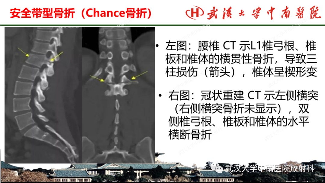 影像PPT - 【PPT】脊柱外伤的影像分析-19