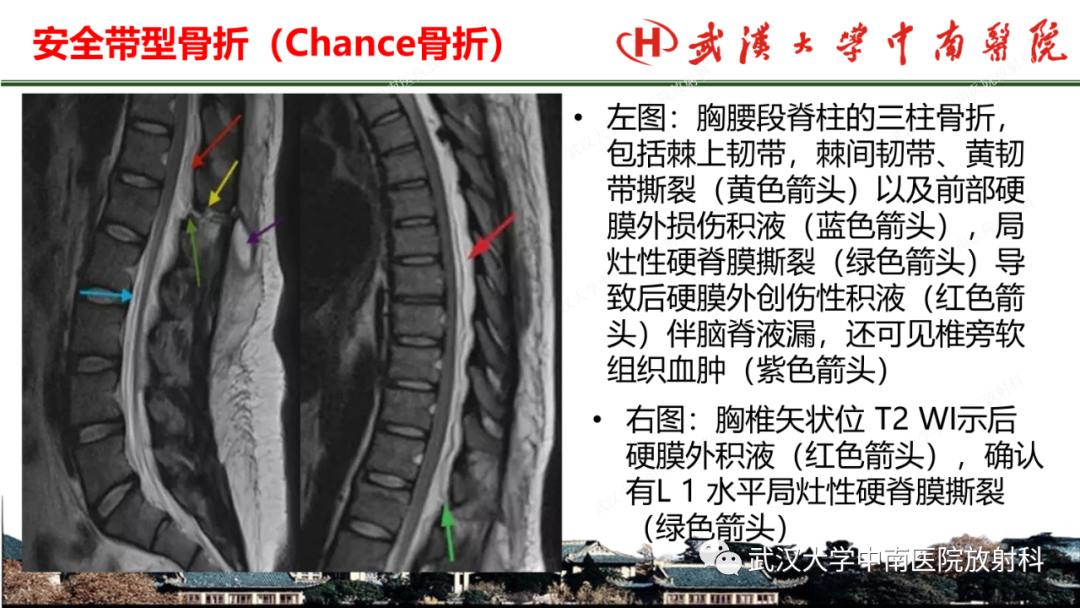 影像PPT - 【PPT】脊柱外伤的影像分析-20