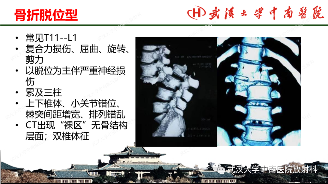 影像PPT - 【PPT】脊柱外伤的影像分析-22