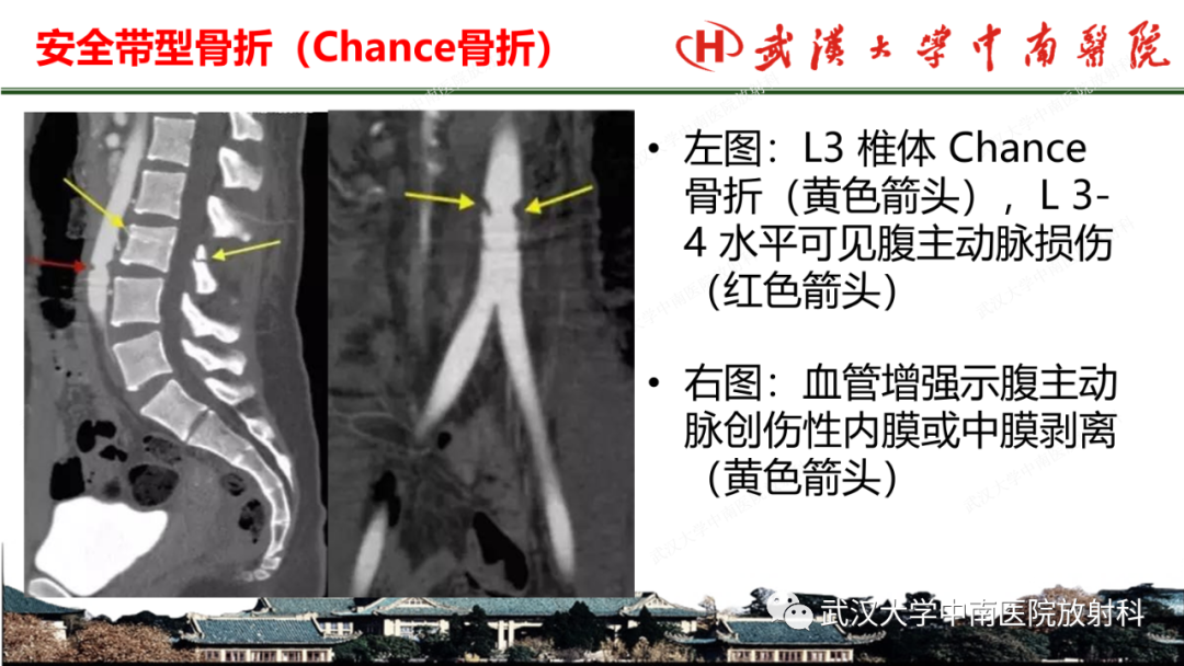 影像PPT - 【PPT】脊柱外伤的影像分析-21