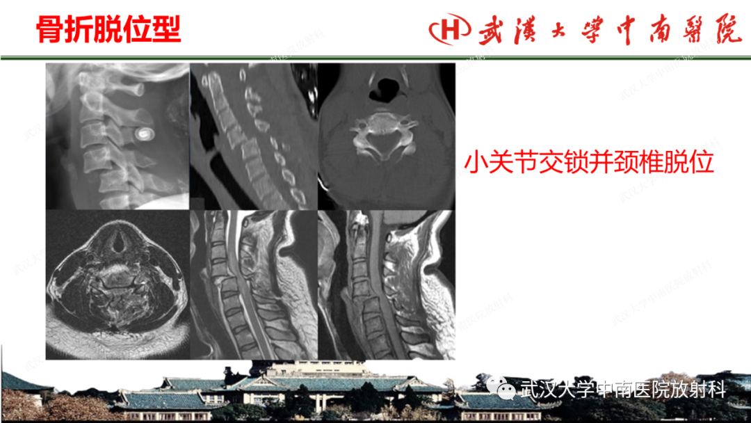 影像PPT - 【PPT】脊柱外伤的影像分析-25