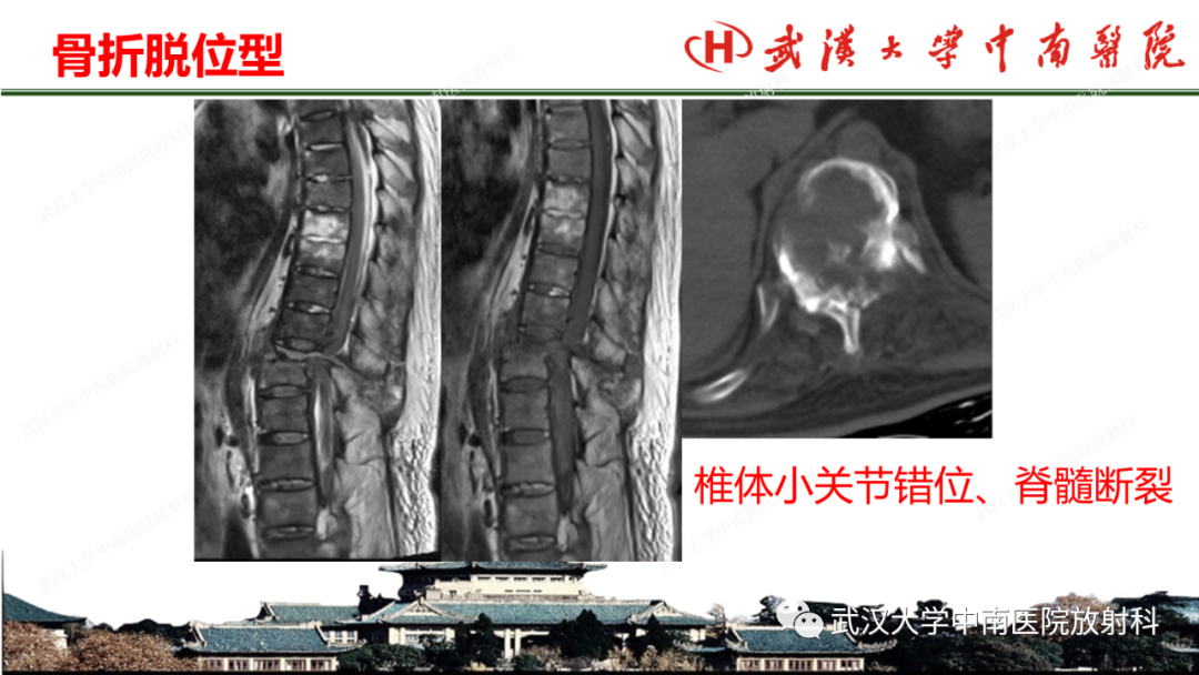 影像PPT - 【PPT】脊柱外伤的影像分析-23