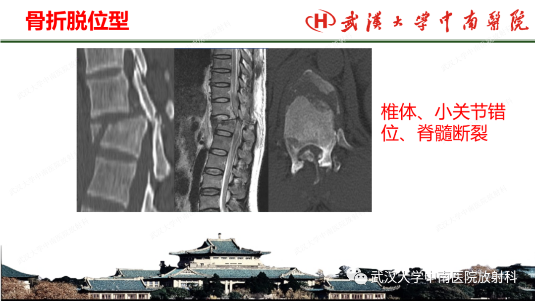 影像PPT - 【PPT】脊柱外伤的影像分析-24
