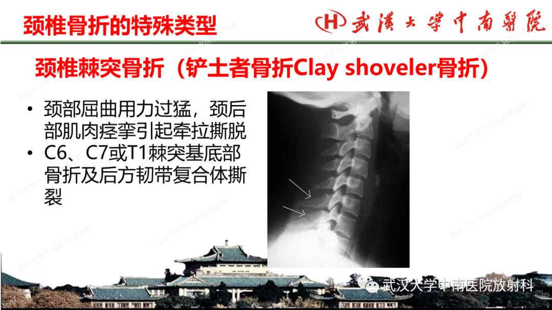 影像PPT - 【PPT】脊柱外伤的影像分析-27