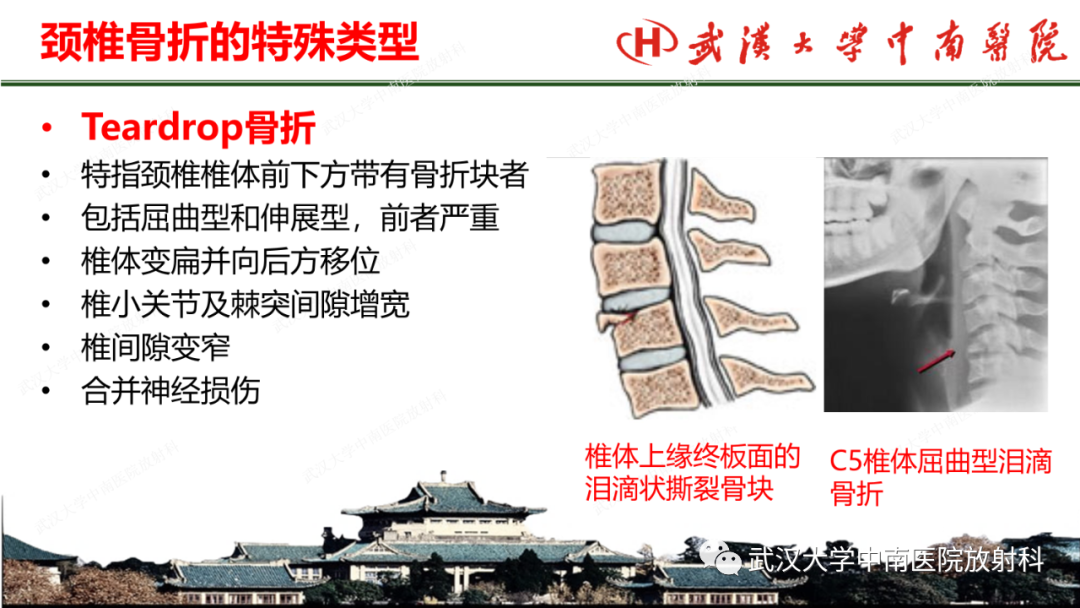 影像PPT - 【PPT】脊柱外伤的影像分析-30