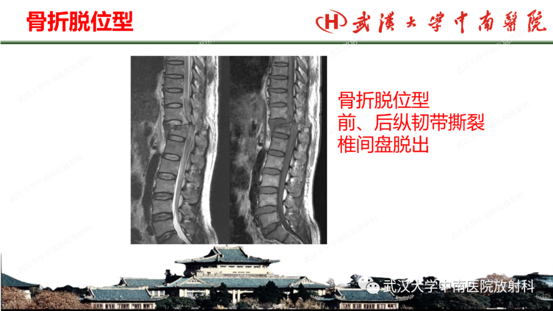 影像PPT - 【PPT】脊柱外伤的影像分析-26