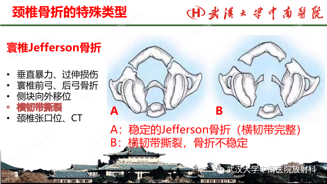 影像PPT - 【PPT】脊柱外伤的影像分析-28