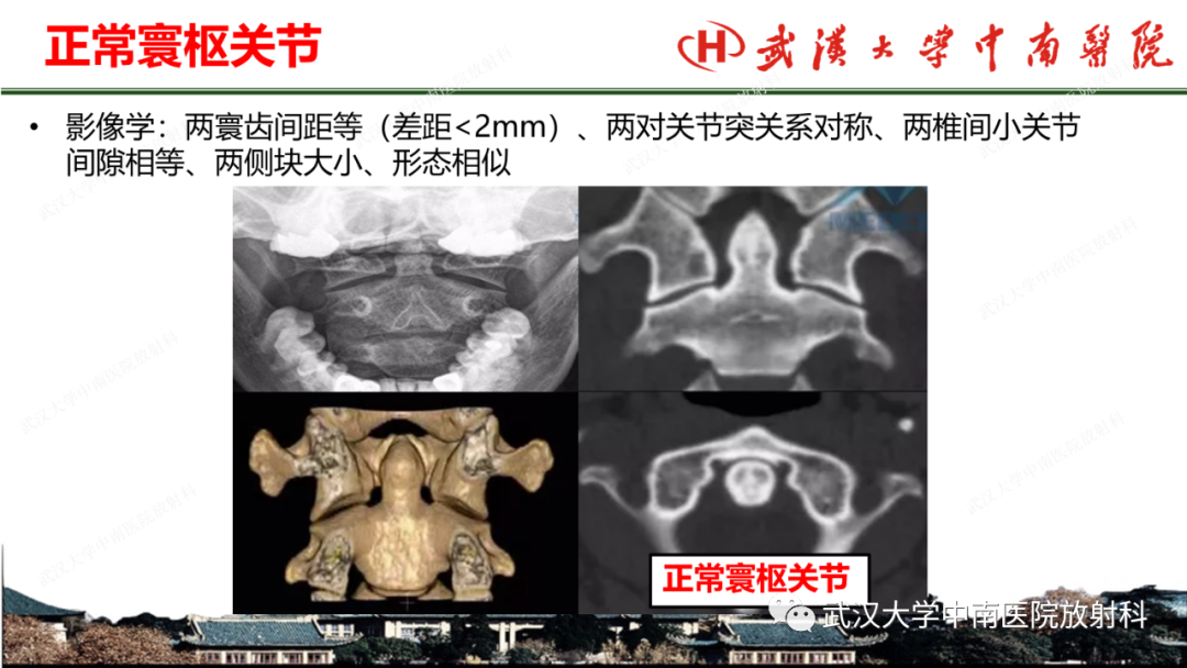 影像PPT - 【PPT】脊柱外伤的影像分析-34