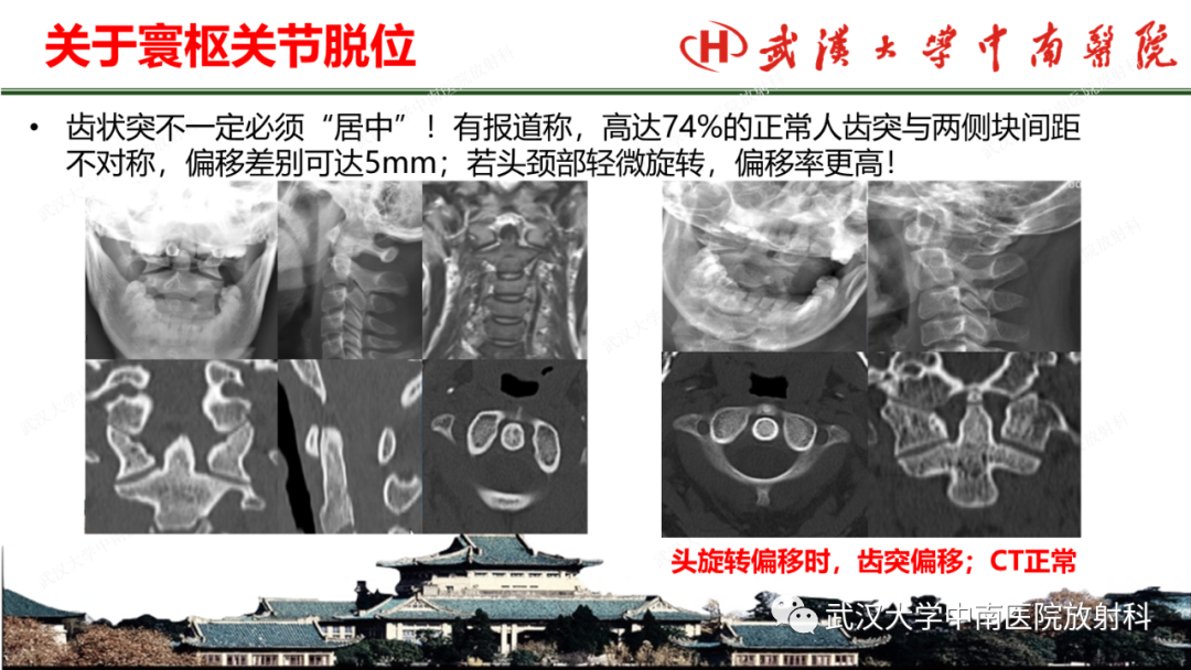 影像PPT - 【PPT】脊柱外伤的影像分析-33