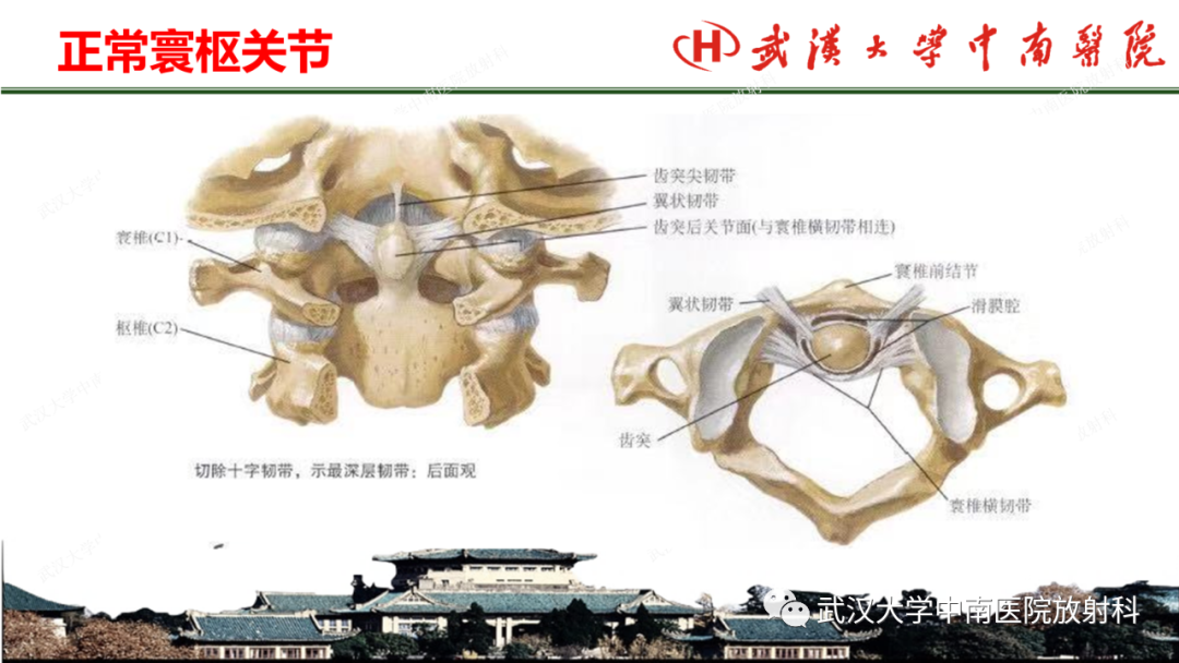 影像PPT - 【PPT】脊柱外伤的影像分析-32