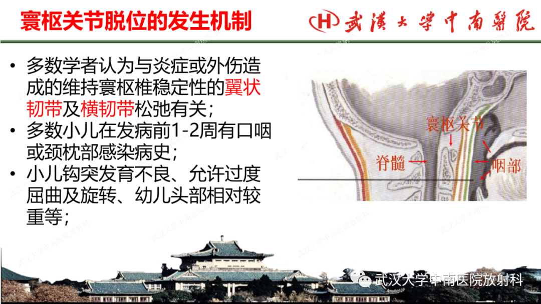 影像PPT - 【PPT】脊柱外伤的影像分析-36