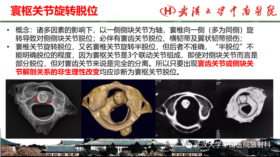 影像PPT - 【PPT】脊柱外伤的影像分析-38