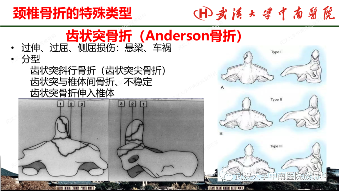 影像PPT - 【PPT】脊柱外伤的影像分析-29