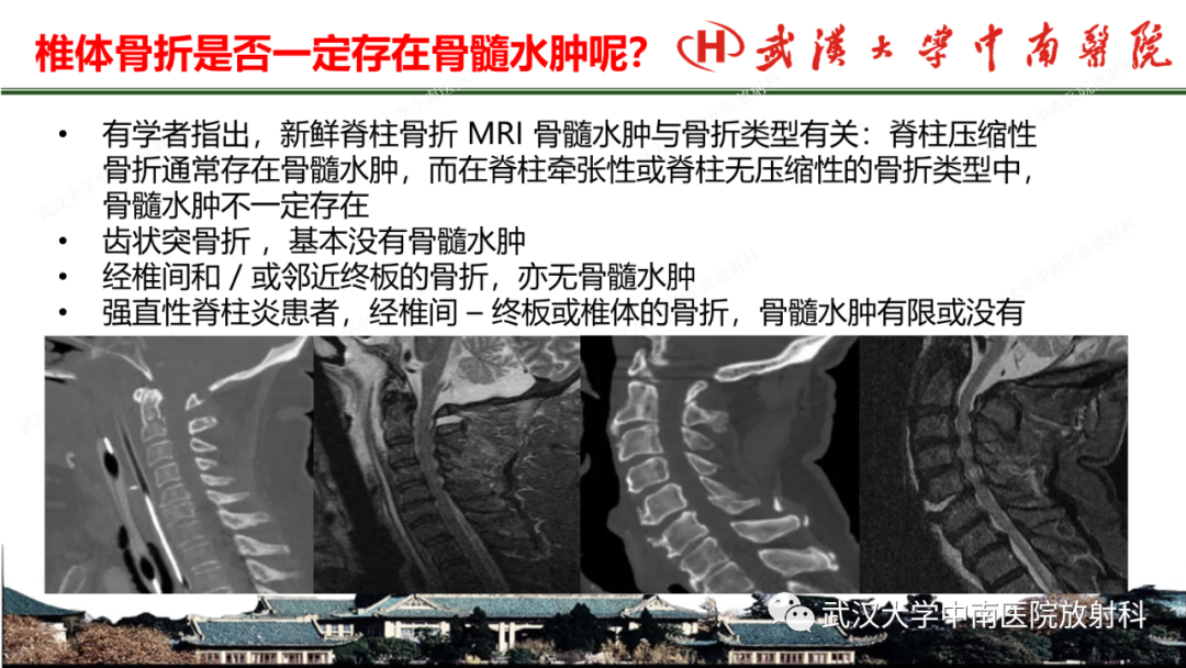影像PPT - 【PPT】脊柱外伤的影像分析-40