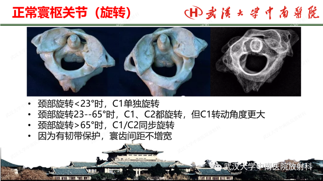 影像PPT - 【PPT】脊柱外伤的影像分析-35