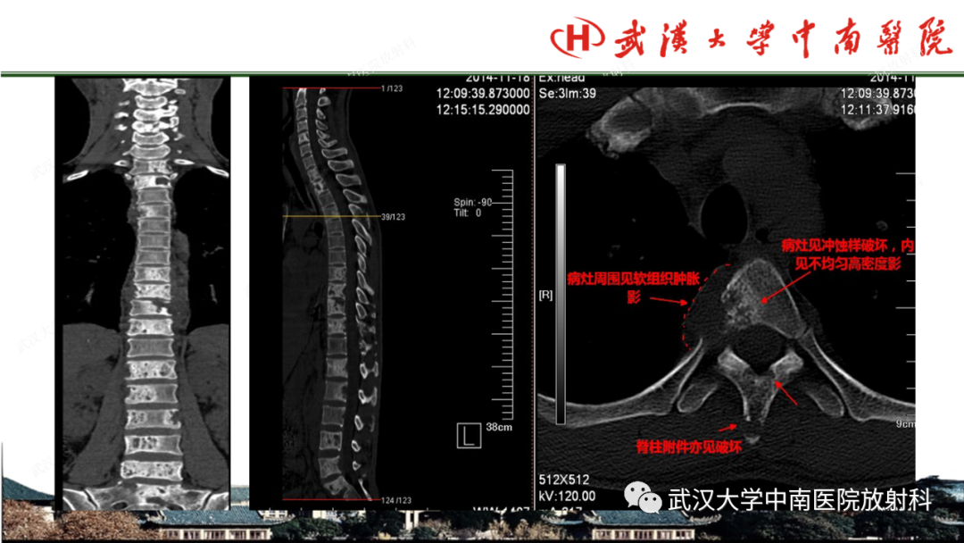 影像PPT - 【PPT】脊柱外伤的影像分析-46