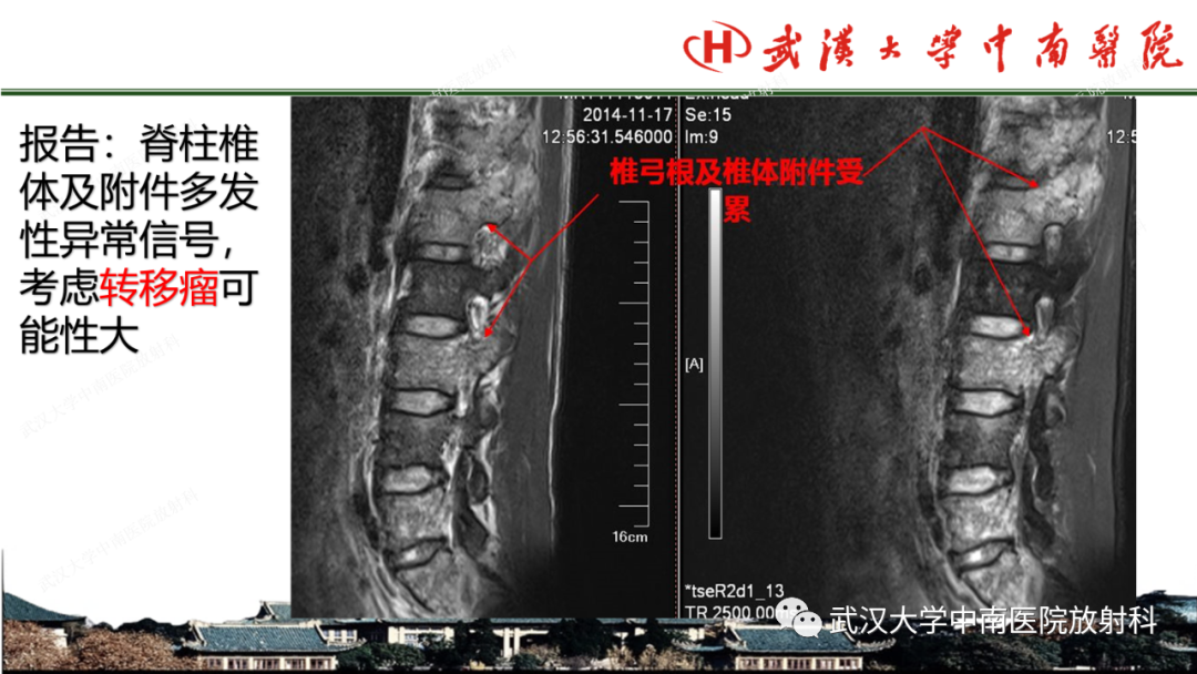 影像PPT - 【PPT】脊柱外伤的影像分析-45