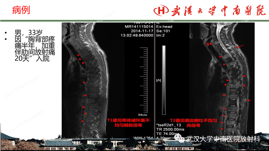 影像PPT - 【PPT】脊柱外伤的影像分析-43