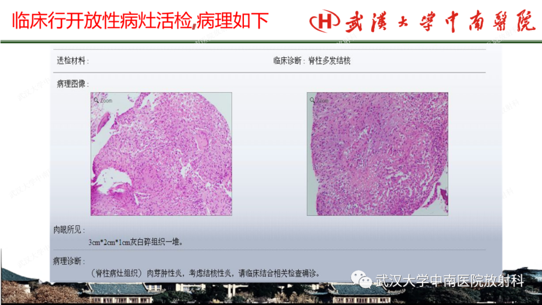 影像PPT - 【PPT】脊柱外伤的影像分析-49