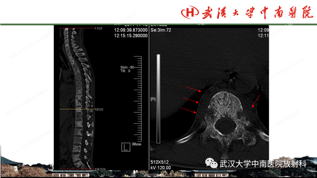 影像PPT - 【PPT】脊柱外伤的影像分析-48