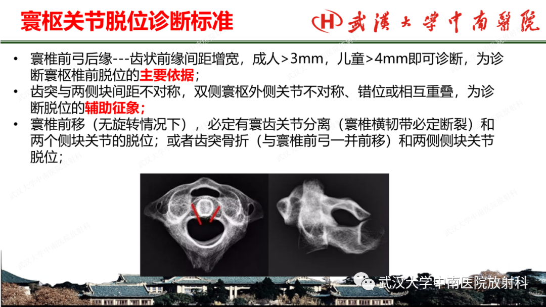 影像PPT - 【PPT】脊柱外伤的影像分析-37