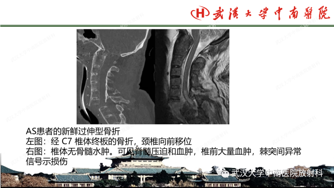 影像PPT - 【PPT】脊柱外伤的影像分析-41