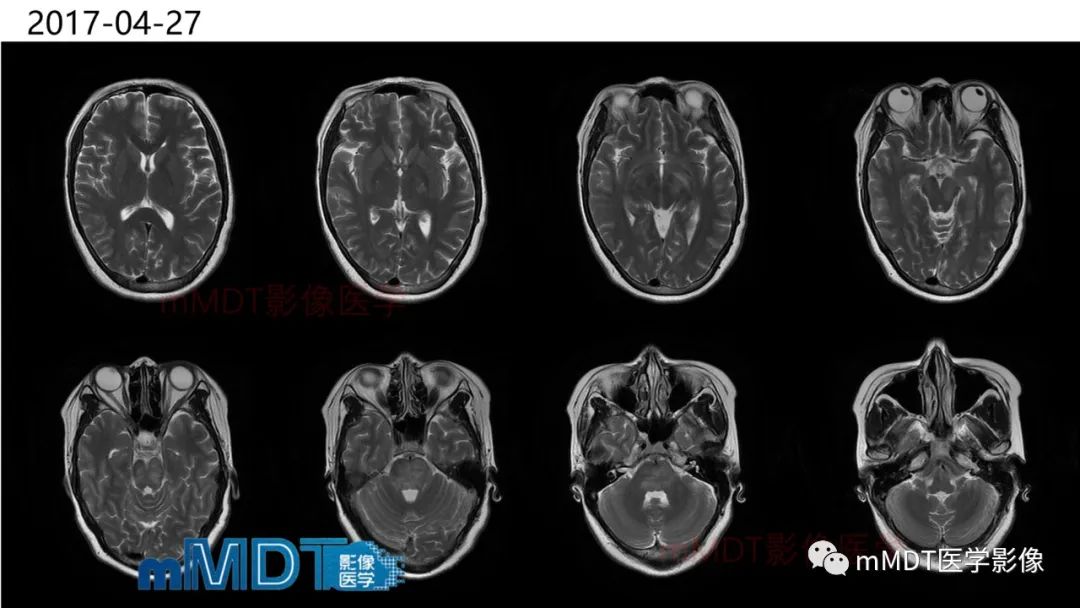 影像PPT - 【PPT】神经白塞病病例分析及综述-6 影像PPT - 【PPT】神经白塞病病例分析及综述-6