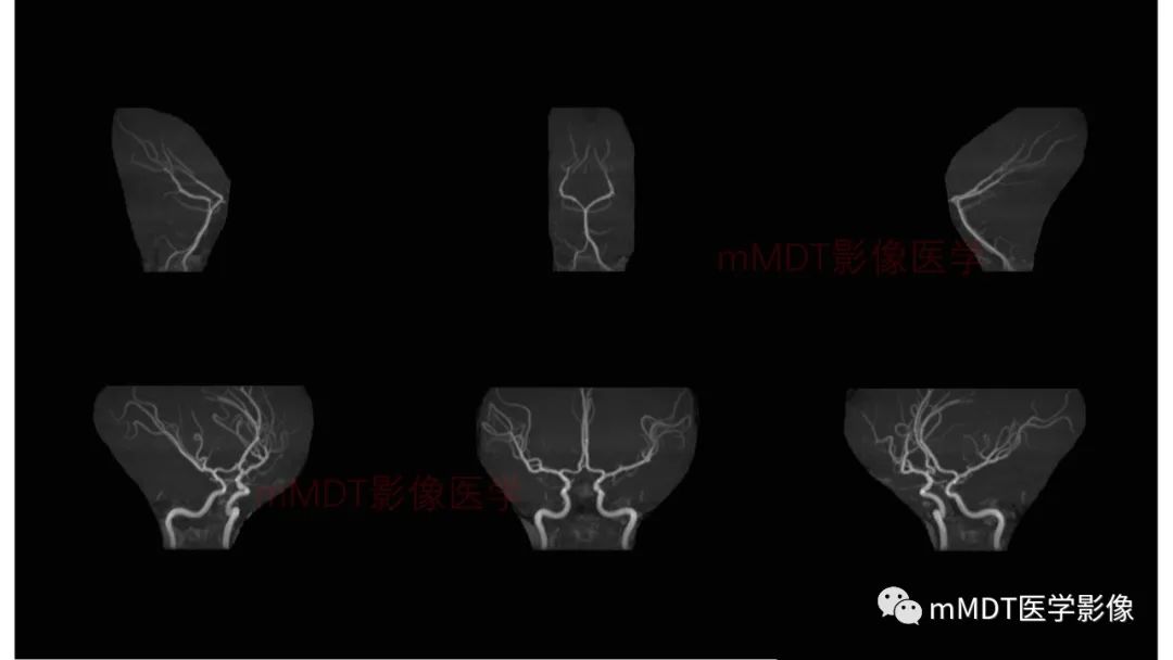 影像PPT - 【PPT】神经白塞病病例分析及综述-17 影像PPT - 【PPT】神经白塞病病例分析及综述-17