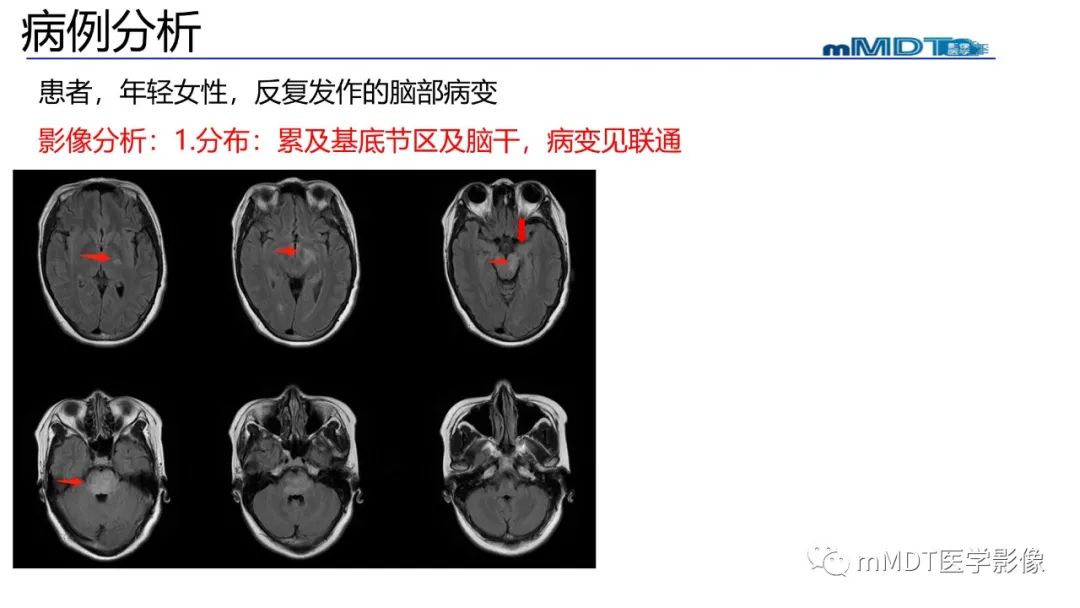 影像PPT - 【PPT】神经白塞病病例分析及综述-26 影像PPT - 【PPT】神经白塞病病例分析及综述-26