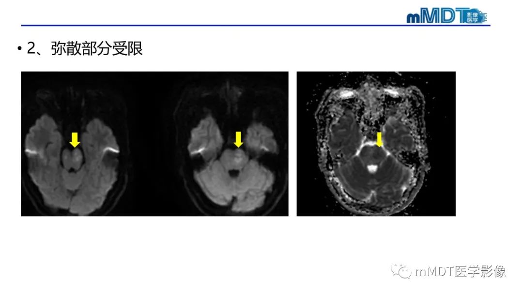影像PPT - 【PPT】神经白塞病病例分析及综述-27 影像PPT - 【PPT】神经白塞病病例分析及综述-27