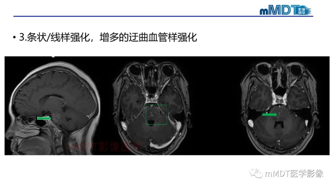 影像PPT - 【PPT】神经白塞病病例分析及综述-28 影像PPT - 【PPT】神经白塞病病例分析及综述-28