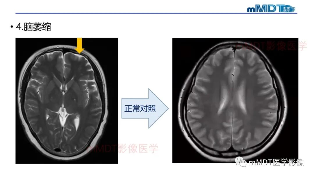 影像PPT - 【PPT】神经白塞病病例分析及综述-29 影像PPT - 【PPT】神经白塞病病例分析及综述-29