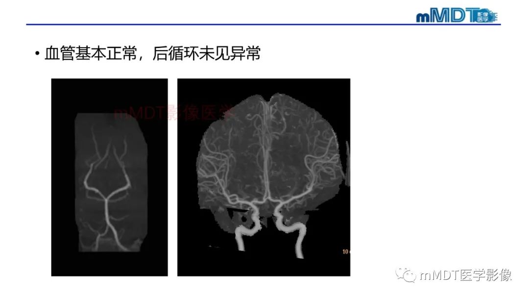 影像PPT - 【PPT】神经白塞病病例分析及综述-30 影像PPT - 【PPT】神经白塞病病例分析及综述-30