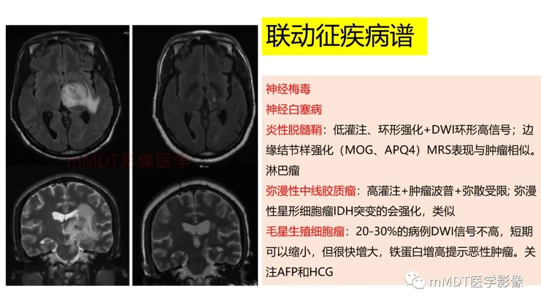 影像PPT - 【PPT】神经白塞病病例分析及综述-36 影像PPT - 【PPT】神经白塞病病例分析及综述-36