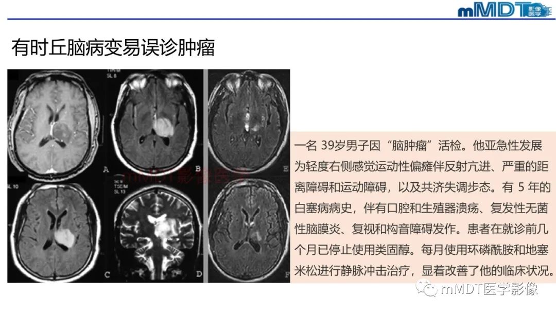 影像PPT - 【PPT】神经白塞病病例分析及综述-37 影像PPT - 【PPT】神经白塞病病例分析及综述-37