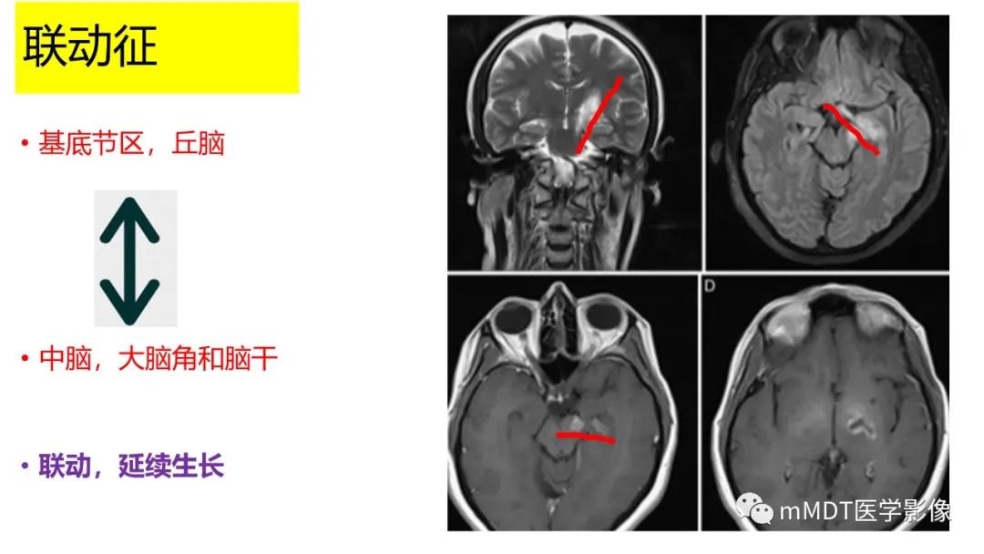 影像PPT - 【PPT】神经白塞病病例分析及综述-35 影像PPT - 【PPT】神经白塞病病例分析及综述-35