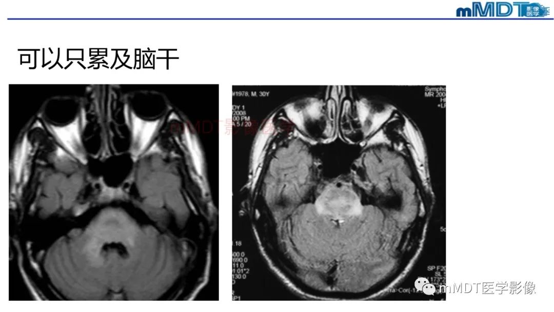 影像PPT - 【PPT】神经白塞病病例分析及综述-39 影像PPT - 【PPT】神经白塞病病例分析及综述-39