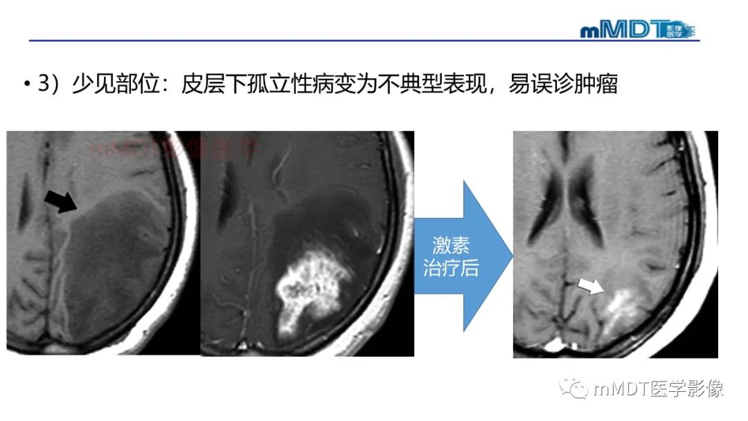 影像PPT - 【PPT】神经白塞病病例分析及综述-43 影像PPT - 【PPT】神经白塞病病例分析及综述-43
