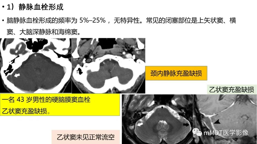 影像PPT - 【PPT】神经白塞病病例分析及综述-45 影像PPT - 【PPT】神经白塞病病例分析及综述-45