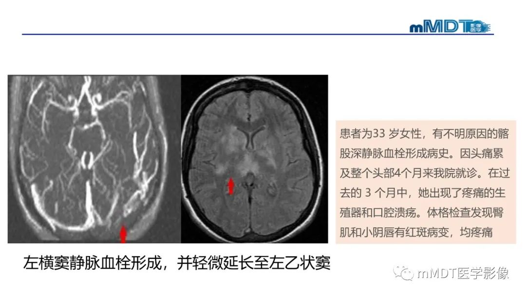 影像PPT - 【PPT】神经白塞病病例分析及综述-46