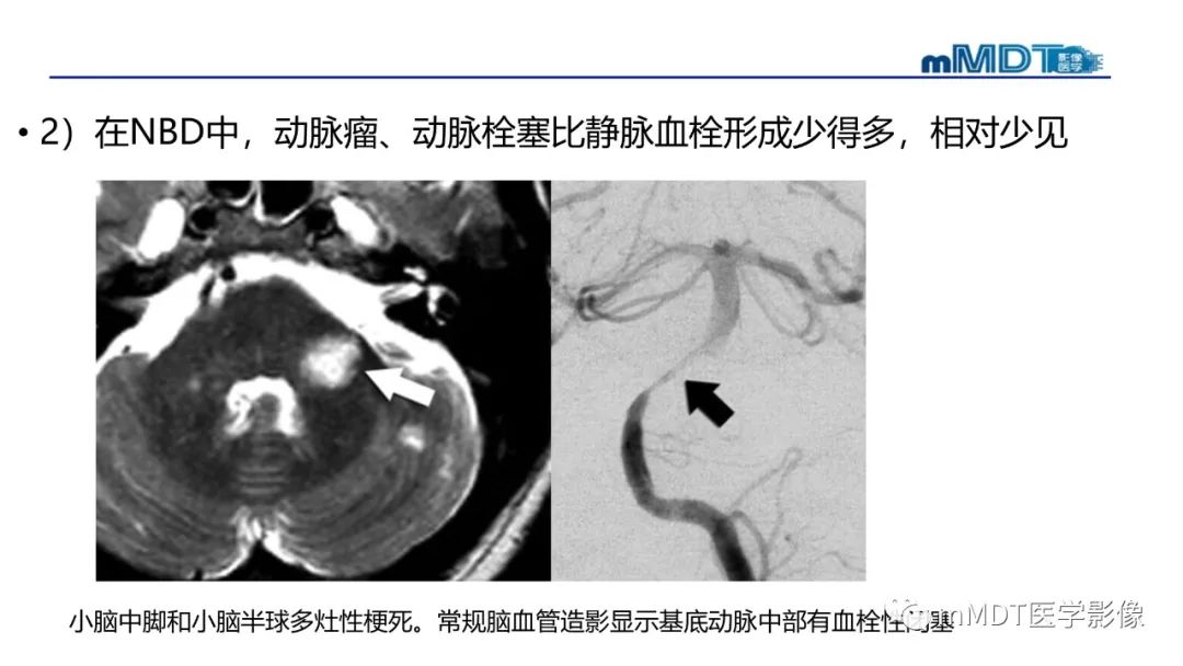 影像PPT - 【PPT】神经白塞病病例分析及综述-47 影像PPT - 【PPT】神经白塞病病例分析及综述-47