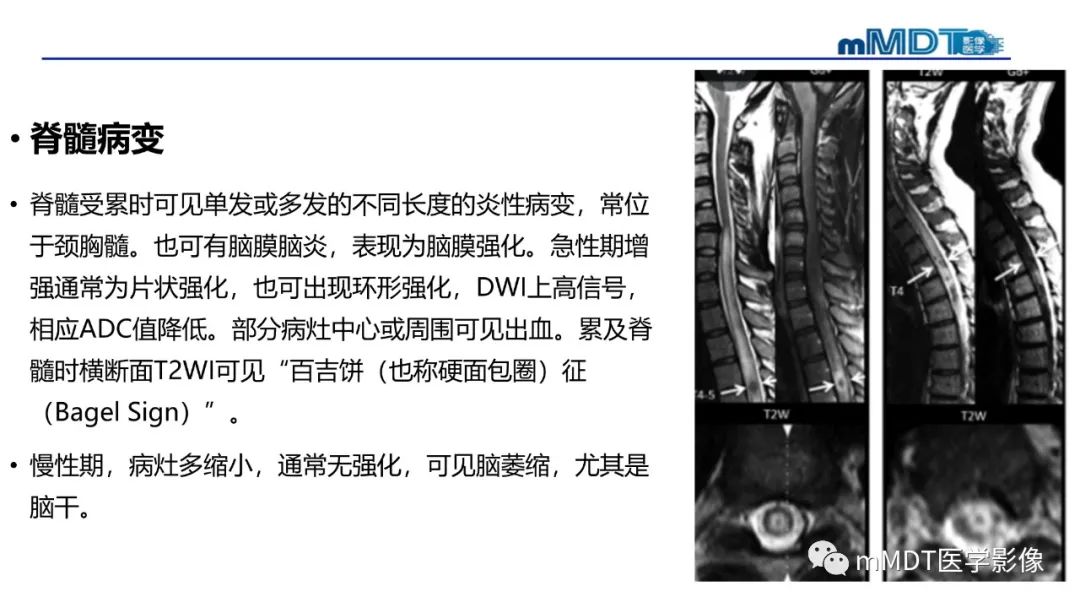 影像PPT - 【PPT】神经白塞病病例分析及综述-48 影像PPT - 【PPT】神经白塞病病例分析及综述-48