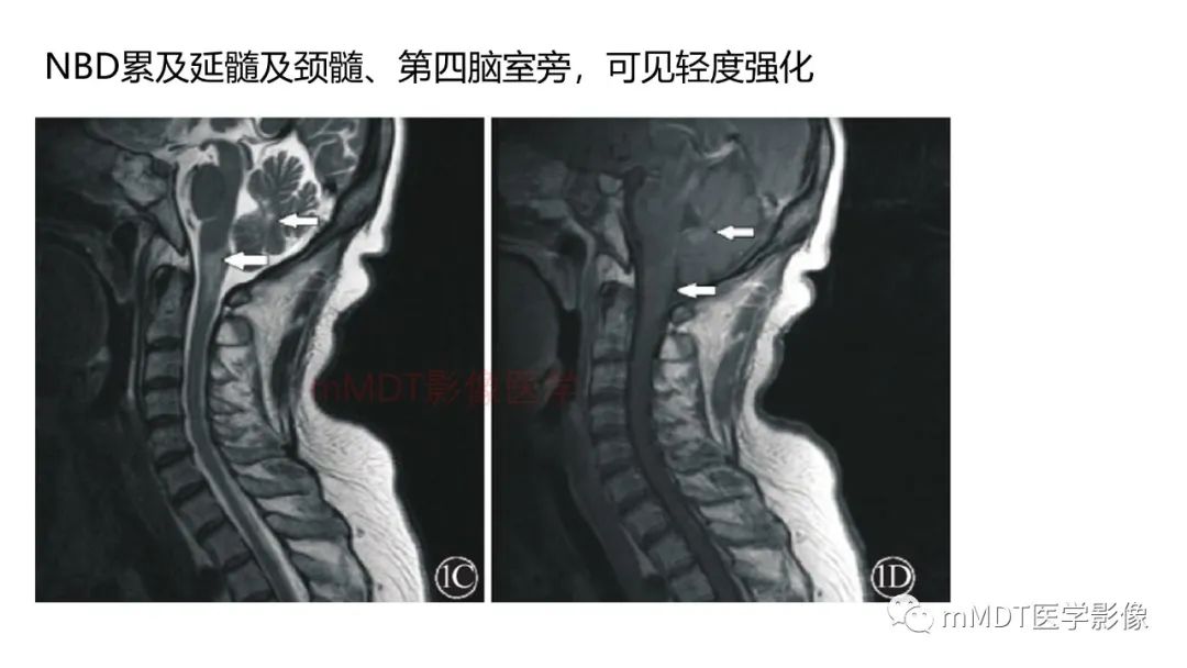 影像PPT - 【PPT】神经白塞病病例分析及综述-50 影像PPT - 【PPT】神经白塞病病例分析及综述-50