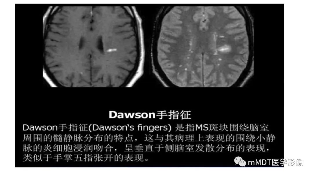 影像PPT - 【PPT】神经白塞病病例分析及综述-54 影像PPT - 【PPT】神经白塞病病例分析及综述-54
