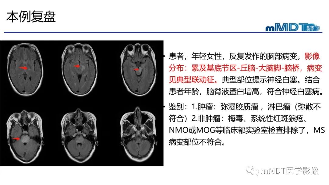 影像PPT - 【PPT】神经白塞病病例分析及综述-57 影像PPT - 【PPT】神经白塞病病例分析及综述-57