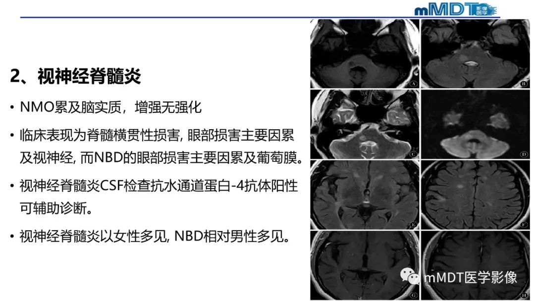 影像PPT - 【PPT】神经白塞病病例分析及综述-55 影像PPT - 【PPT】神经白塞病病例分析及综述-55