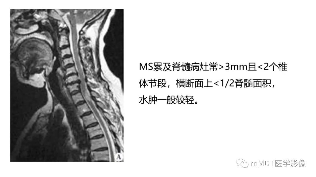 影像PPT - 【PPT】神经白塞病病例分析及综述-53 影像PPT - 【PPT】神经白塞病病例分析及综述-53