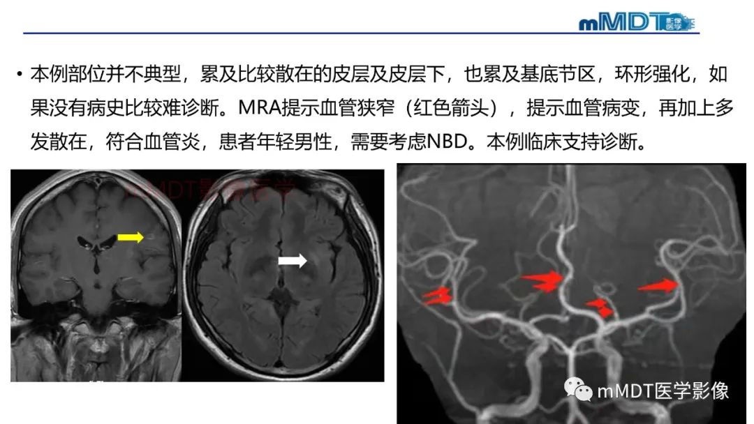 影像PPT - 【PPT】神经白塞病病例分析及综述-61 影像PPT - 【PPT】神经白塞病病例分析及综述-61
